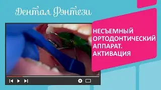 🔎 Несъемный ортодонтический аппарат. Правила активации для родителей