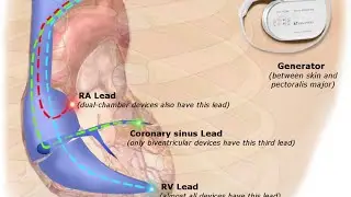 Cardiac pacemakers : History, basic function, Mode, issues, Indication, Troubleshooting, Management