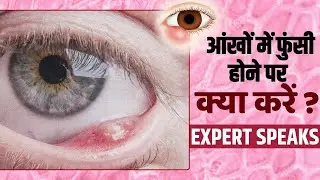 Eye Infection Prevention: बरसात के मौसम में आंखों में होती है ये दर्दनाक समस्या! जानें इलाज