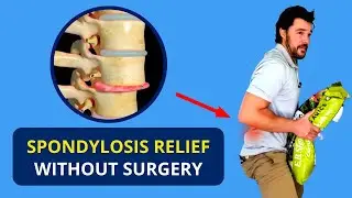 Spondylosis Treatment Without Surgery 🔥 Spondylolisthesis Causes