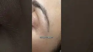 Удаление Микроблейдинга💥Лазерное удаление хвостов бровей