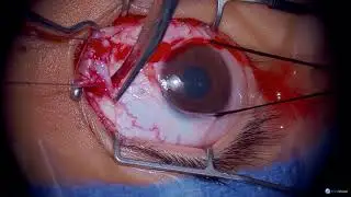 Surgery: Medial Rectus Recession: Dr. Rudolph Wagner