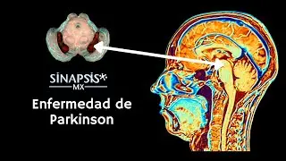 Enfermedad de Parkinson