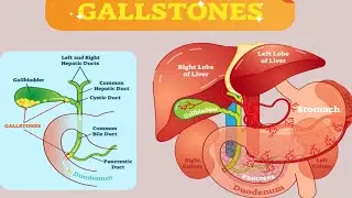 Gallbladder disease.Gallstone.gallbladder functions.cholycestitis.gallbladder pain.