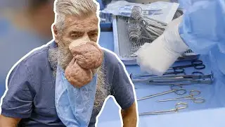 ELLE SOIGNE SON ÉNORME PROBLÈME AU NEZ !