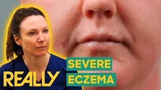 Dr. Emma Treats Woman With Extremely Painful Eczema | The Bad Skin Clinic