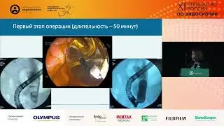 Первый опыт комплексного лечения сложного холедохолитиаза путем контактной лазерной литотрипсии