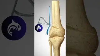 Distal Femoral Osteotomy of the Knee - 3D animation 