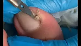 Best toenails treatment