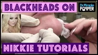Blackhead Extractions: NikkieTutorials & Dr Pimple Popper!