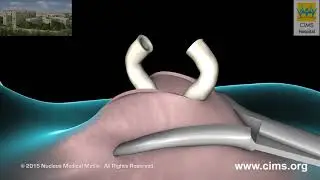 Vasectomy – CIMS Hospital