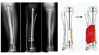 Congenital Pseudarthrosis of Tibia