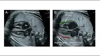 Enhancement of fetal cardiac screening as proposed by the ISUOG Practice Guidelines