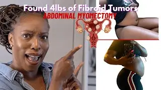 Fibroids | The Struggle, Diagnosis, and the Surgery |Abdominal Myomectomy