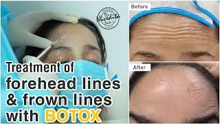 Botox Before And After | Botox Injections | Treatment of Forehead Lines and Frown Lines with Botox