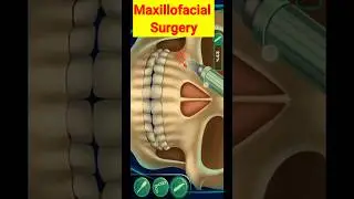 Maxillofacial Surgery #animation #oralsurgery #shortvideo #shorts #asmr