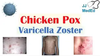 Chickenpox | Varicella Zoster Virus | Pathogenesis, Signs and Symptoms, Diagnosis, and Treatment