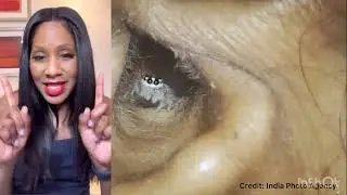 How to Get an Insect Out of Your Ear! 🕷️ A Doctor Explains