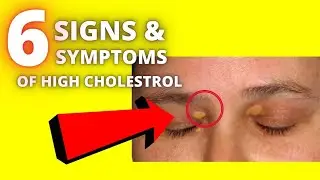 Early Signs of High Cholesterol Causes, Symptoms and Treatment