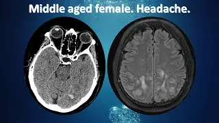 Middle aged female. Headache.