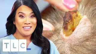 Removing A Horn-Like Growth And 6 Cysts From Womans Head | Dr. Pimple Popper