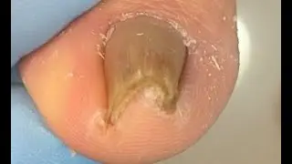 Extremely satisfying ingrown toenail treatment