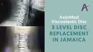 3 Level AxioMed Viscoelastic Disc Replacement in Jamaica