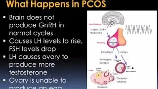 Understanding Polycystic Ovary Syndrome Video – Brigham and Women’s Hospital