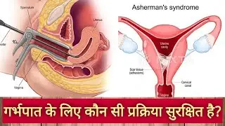 Abortion के लिए कौन सी प्रक्रिया सुरक्षित है?# Pregnancy termination# Asherman's syndrom