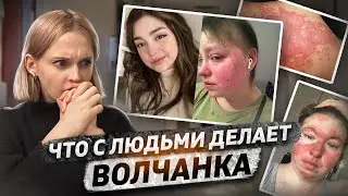 Как живут люди с волчанкой? | СКВ - диагностика, лечение, побочные эффекты