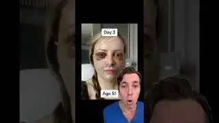 Unbelievable Facelift Recovery