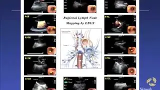Dr. Marc de Perrot on Pleural Mesothelioma