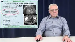 Storosios žarnos divertikuliozė