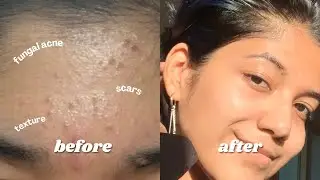 How I GOT RID of My ACNE, SCARS & HYPERPIGMENTATION (Fungal acne tips & Affordable recommendations)