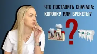 Надо ли снимать коронку перед лечением на брекетах❓