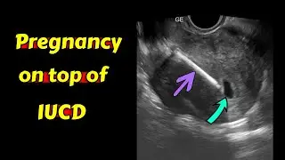 Pregnancy on top of IUCD | Ultrasound Case