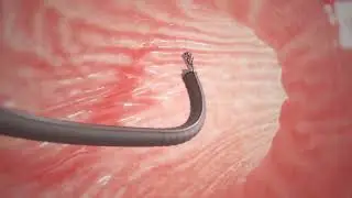 Endoscopic Sleeve Gastroplasty (ESG)