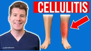 Doctor explains CELLULITIS (skin infection) | Causes, symptoms, treatment (plus photos)