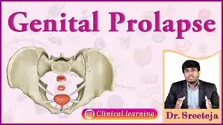 28. Genital Prolapse