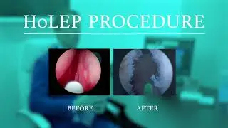 Holmium Laser Enucleation of the Prostate (HoLEP)