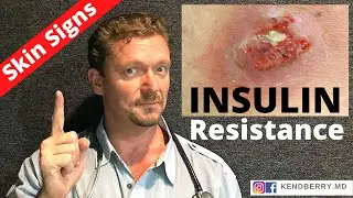 7 Skin Signs of INSULIN RESISTANCE (Root Cause 2024) WARNING: Graphic