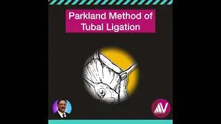 Parkland Method of Tubal Ligation