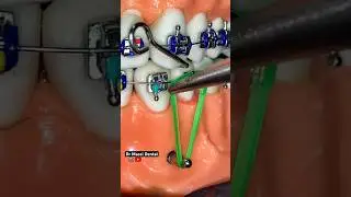 BRACES,ORTHODONTICS treatments #viral #youtubeshorts #trending #dentist #fashion #twitch #smile #ins