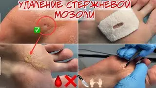 Удаление стержневой мозоли