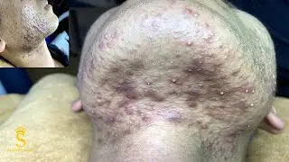 Best Pimple Popping P2 | Mụn Dậy Thì Siêu Hấp Dẫn P2 - SacDepSpa#182