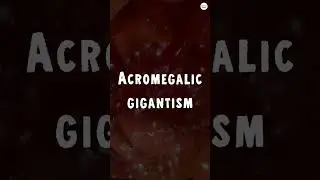 Acromegalic Gigantism: How a Tumor Turns You Into a Giant