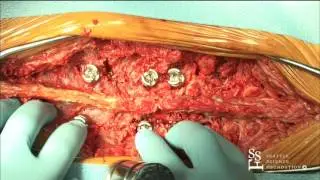 Vertebrectomy/Vertebral Column Resection Demonstration by Sigurd Berven, MD