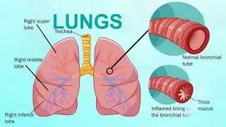 Difference Between Bronchitis and Bronchiectasis