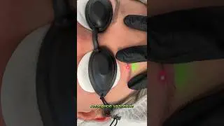 Удаление татуажа бровей