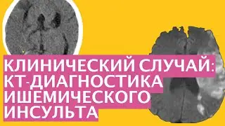 Клинический случай : Ишемический инсульт